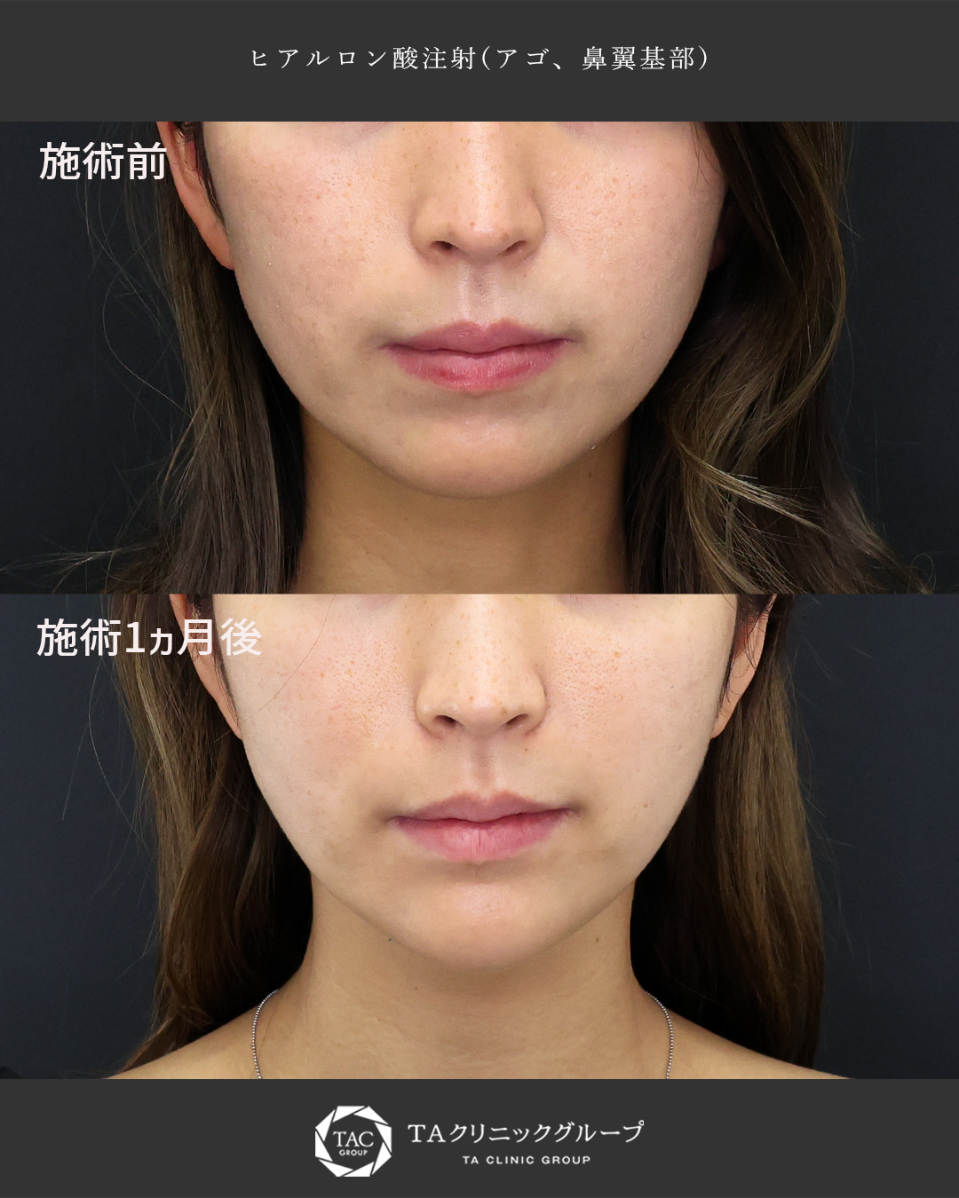 【20代】輪郭を整え、小鼻横の凹み改善│ヒアルロン酸注射