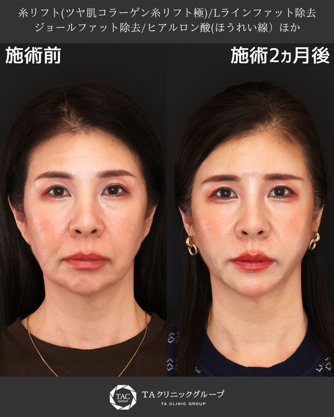 《糸リフト×ジョールファット除去で劇的フェイスライン改善｜ほうれい線・たるみ治療2ヶ月後の症例》