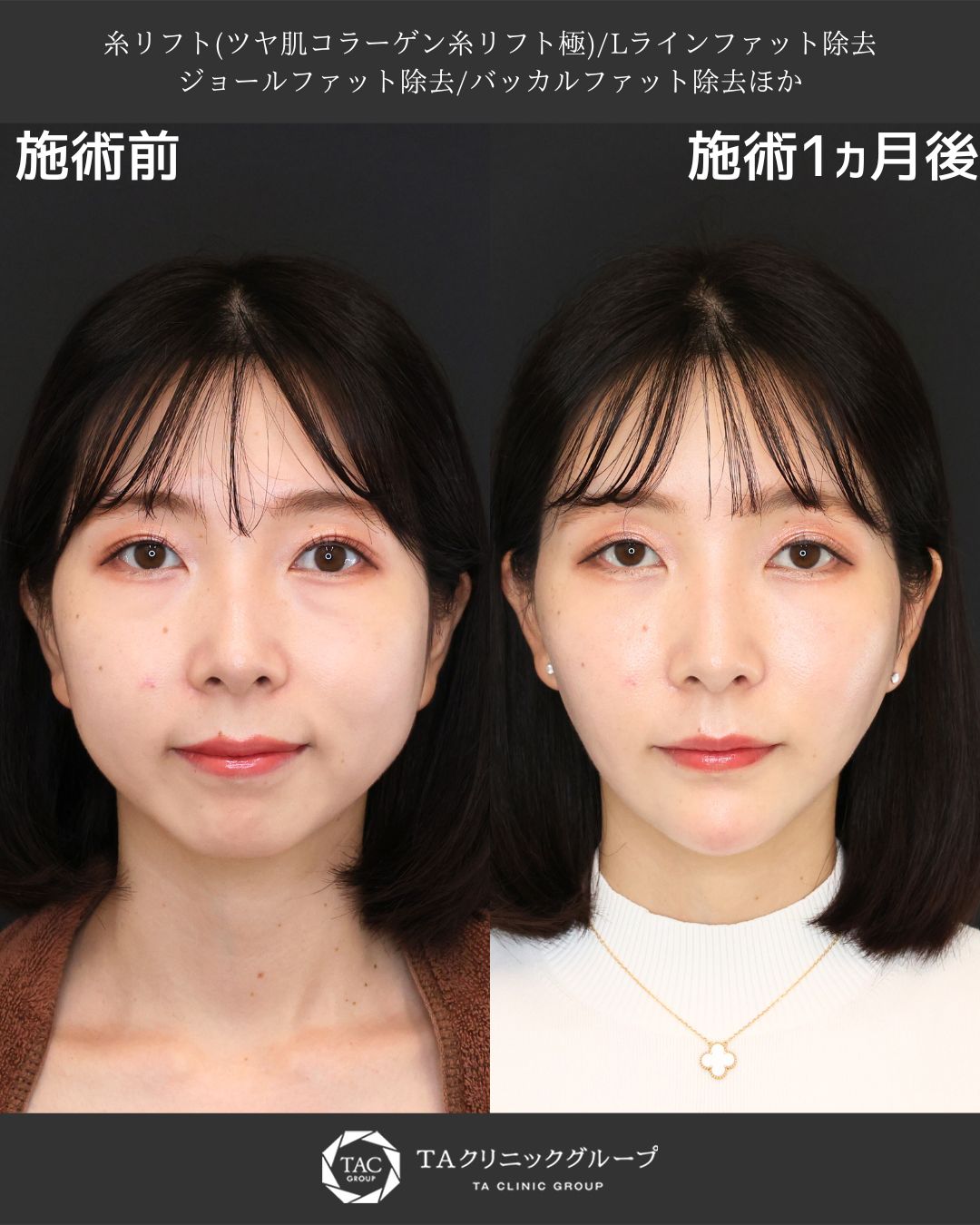 まりえ先生執刀Ⅰたるみ・エラ張り・丸顔をまとめて改善！複合小顔治療