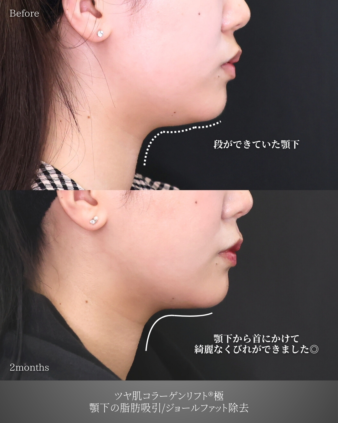 ジョールファット除去/顎下の脂肪吸引・顔の脂肪吸引/TAC式 ツヤ肌コラーゲンリフト®の症例写真 施術前後 