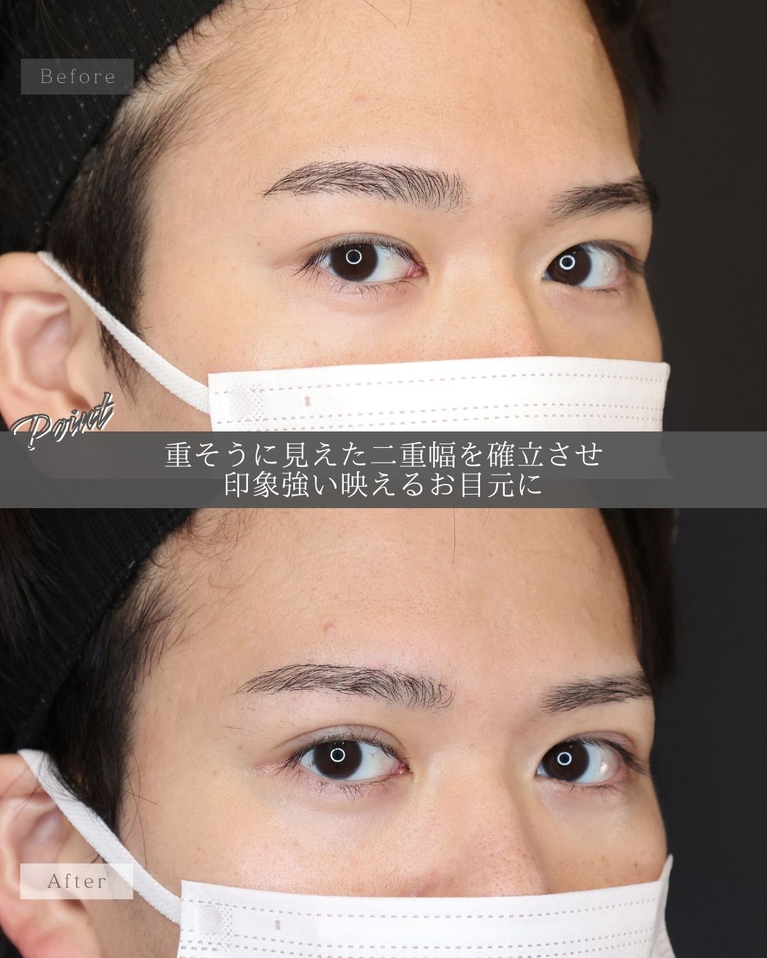 二重埋没法の症例写真 施術前後 