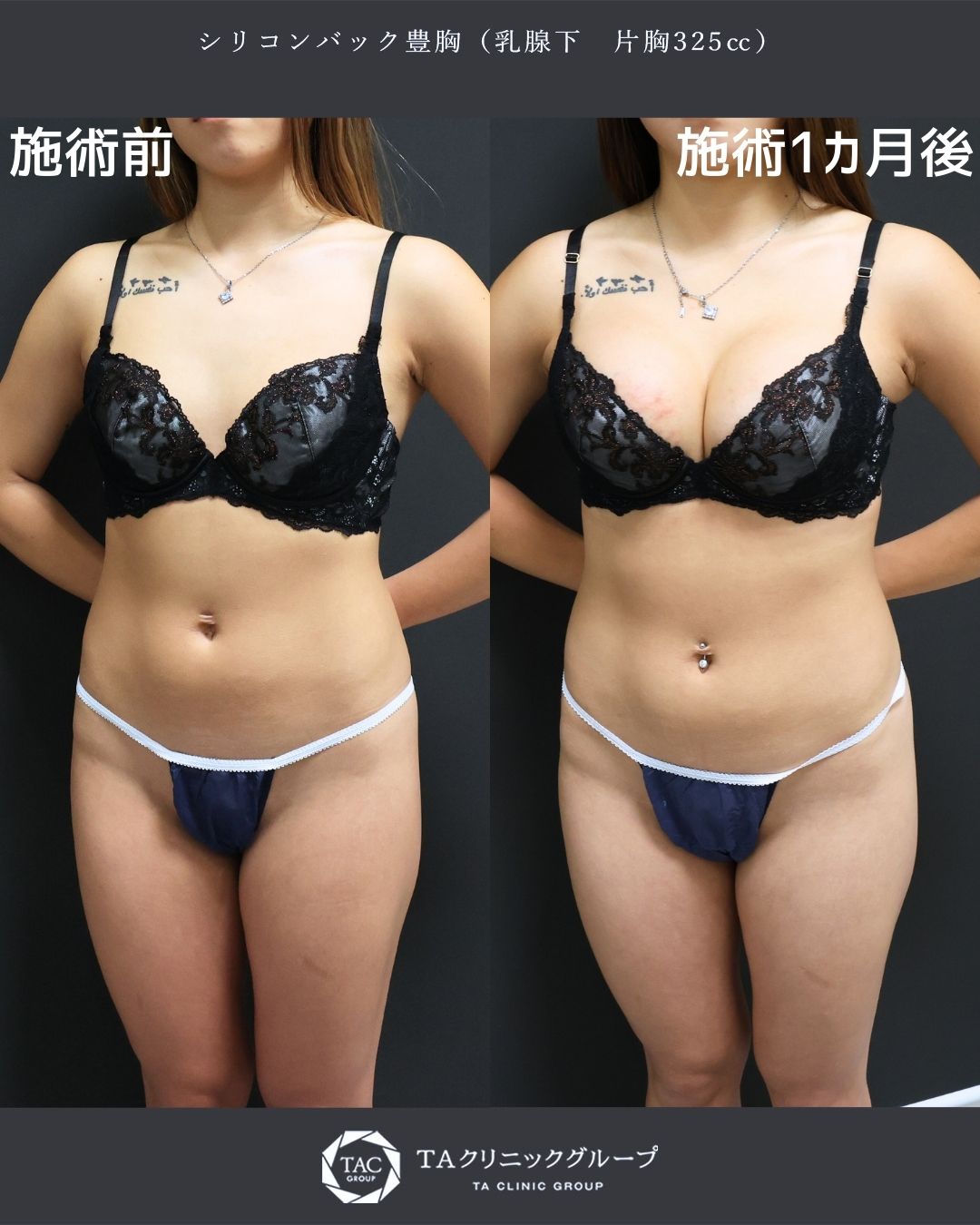 山田真里江院長執刀Ⅰ丸みとボリュームを自然にプラス シリコンバッグ豊胸