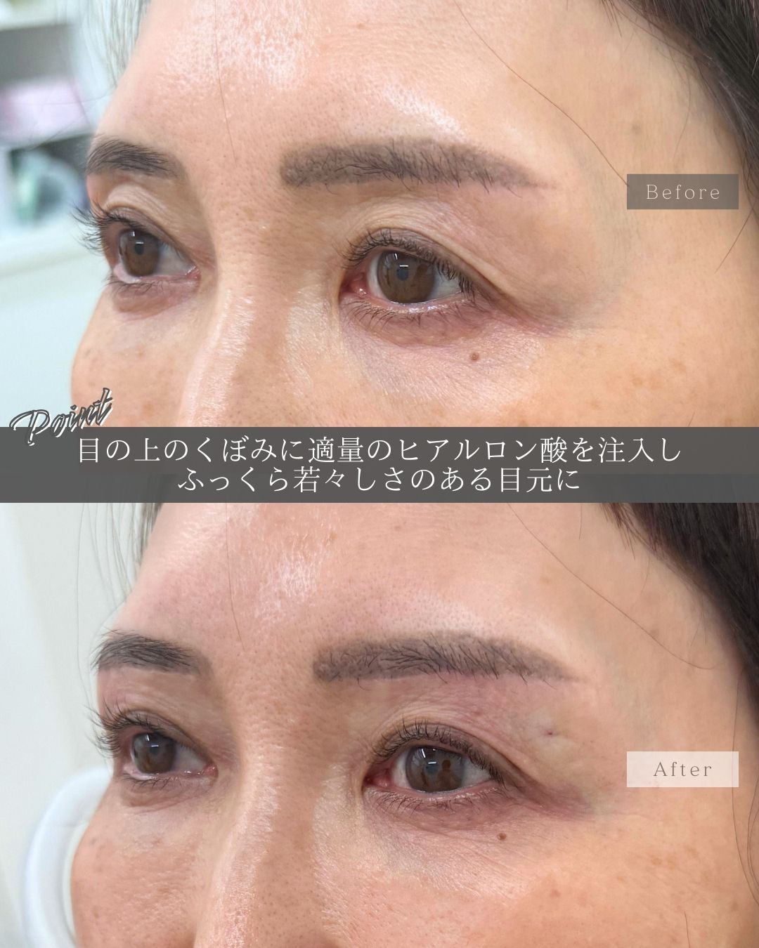 ヒアルロン酸注射：その他の症例写真 施術前後 