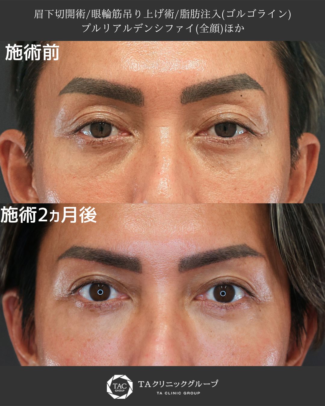 山田真里江院長執刀Ⅰ重たさを解消し、若々しい目元へ