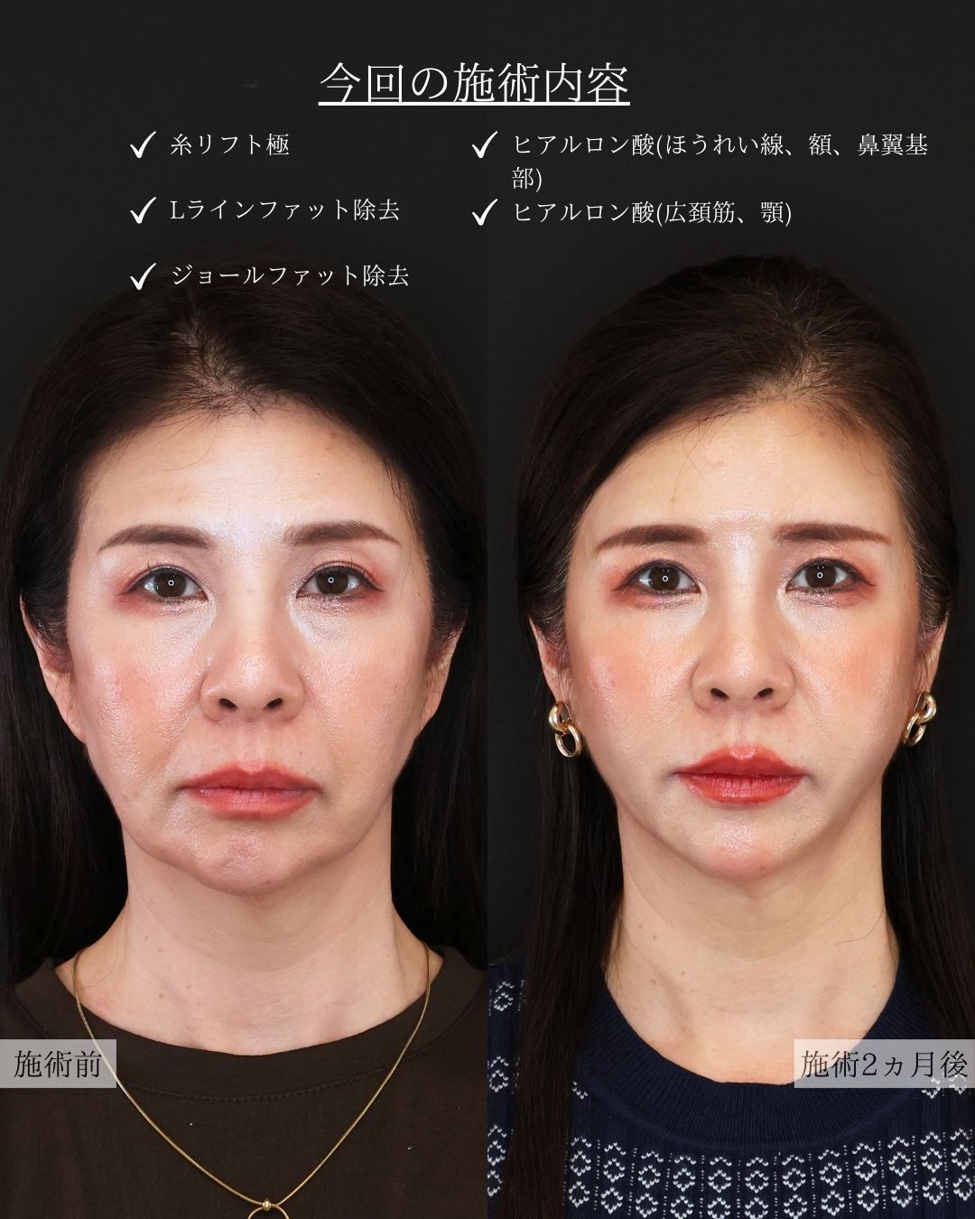 TAC式 ツヤ肌コラーゲンリフト®/Lラインファット除去（エラ下脂肪除去）/ジョールファット除去の症例写真 施術前後 
