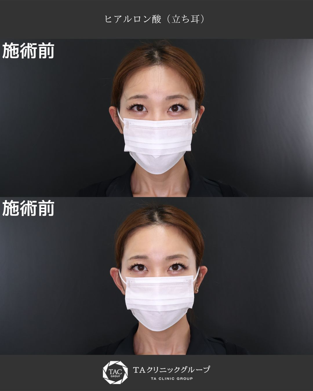 「立ち耳を自然に改善｜ヒアルロン酸注入で手術なしの耳矯正症例」