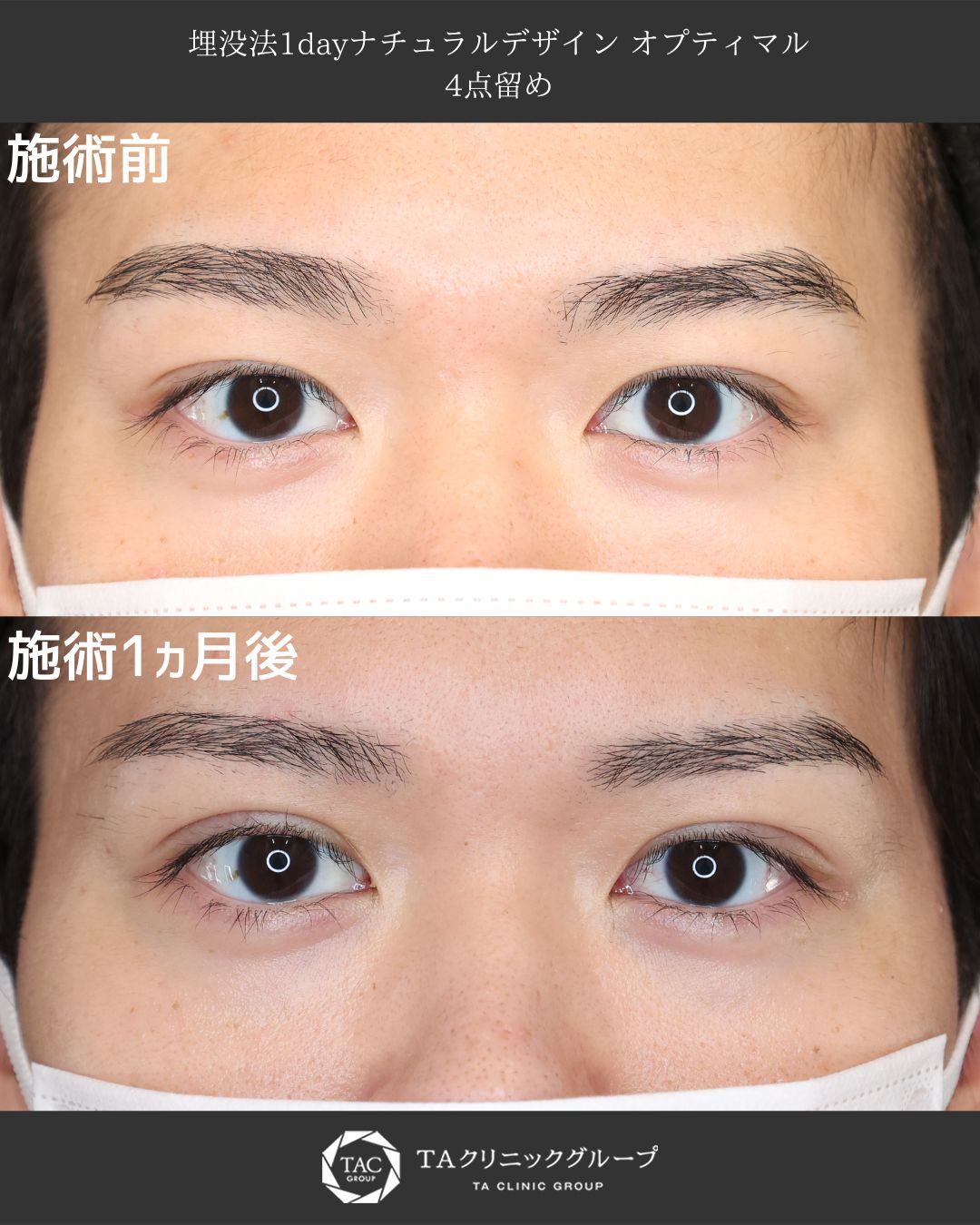 堂脇医師執刀医Ⅰ自然な二重でまぶたの印象を軽やかに