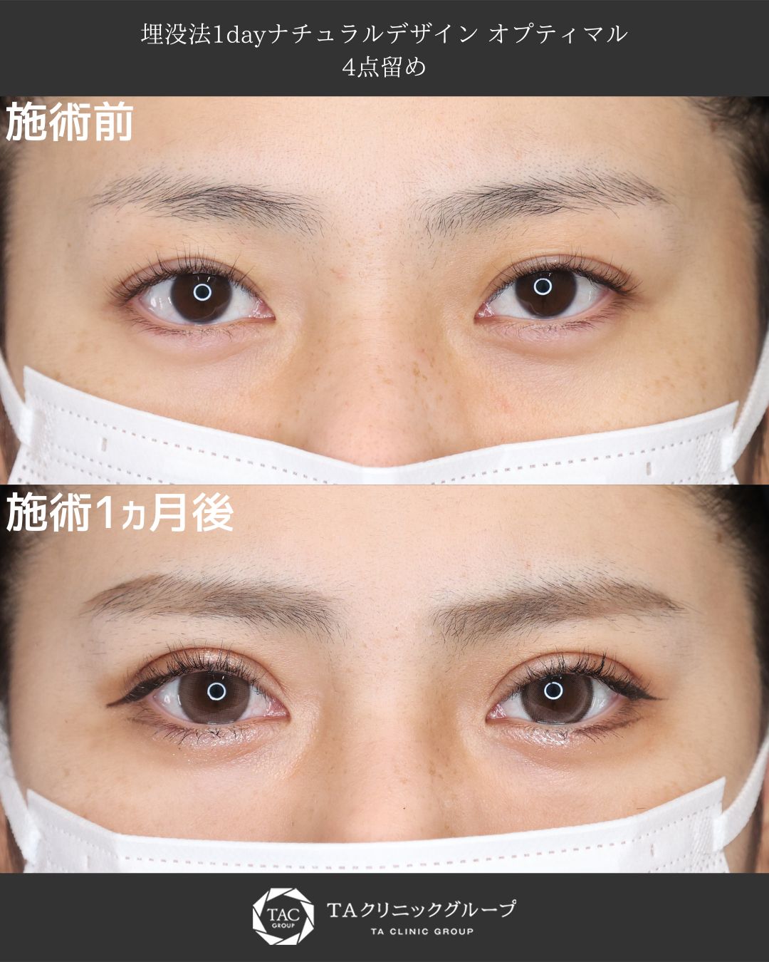 堂脇副院長執刀Ⅰ自然な二重ラインを実現