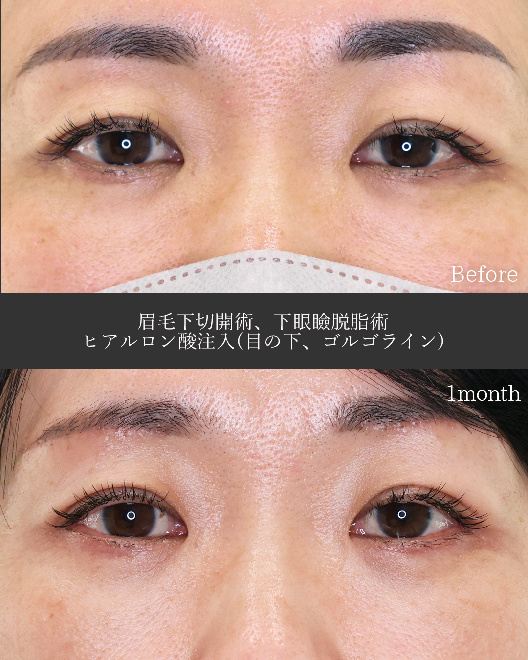 下眼瞼脱脂術（目の下のたるみ取り・目の下の脂肪ふくらみ取り）/眉毛下切開術/目の下のヒアルロン酸注射の症例写真 施術前後 