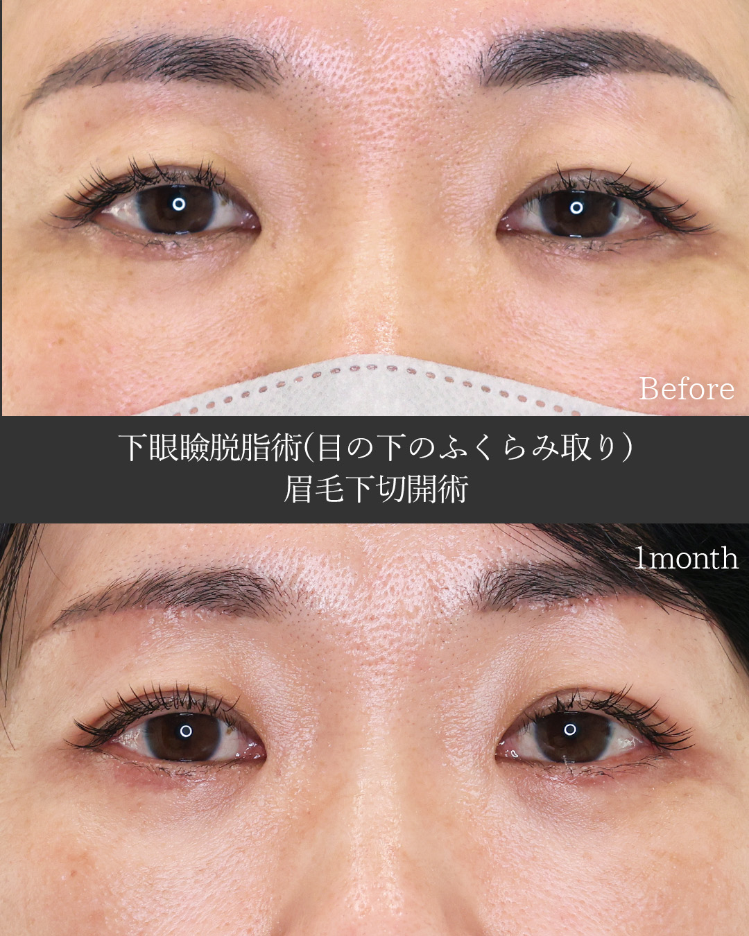下眼瞼脱脂術（目の下のたるみ取り・目の下の脂肪ふくらみ取り）/眉毛下切開術の症例写真 施術前後 