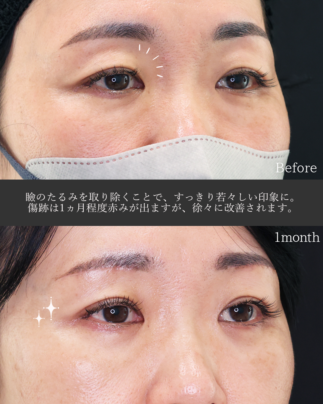 下眼瞼脱脂術（目の下のたるみ取り・目の下の脂肪ふくらみ取り）/眉毛下切開術の症例写真 施術前後 