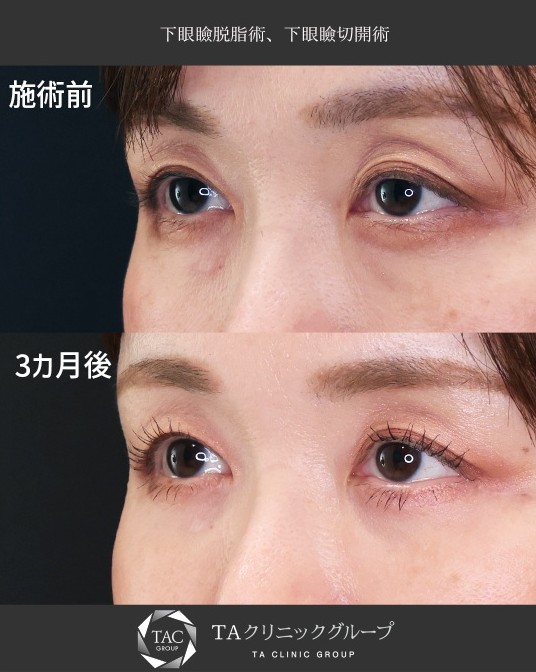 【下眼瞼切開×クマ取り】傷跡ナシ！目の下のたるみ解消