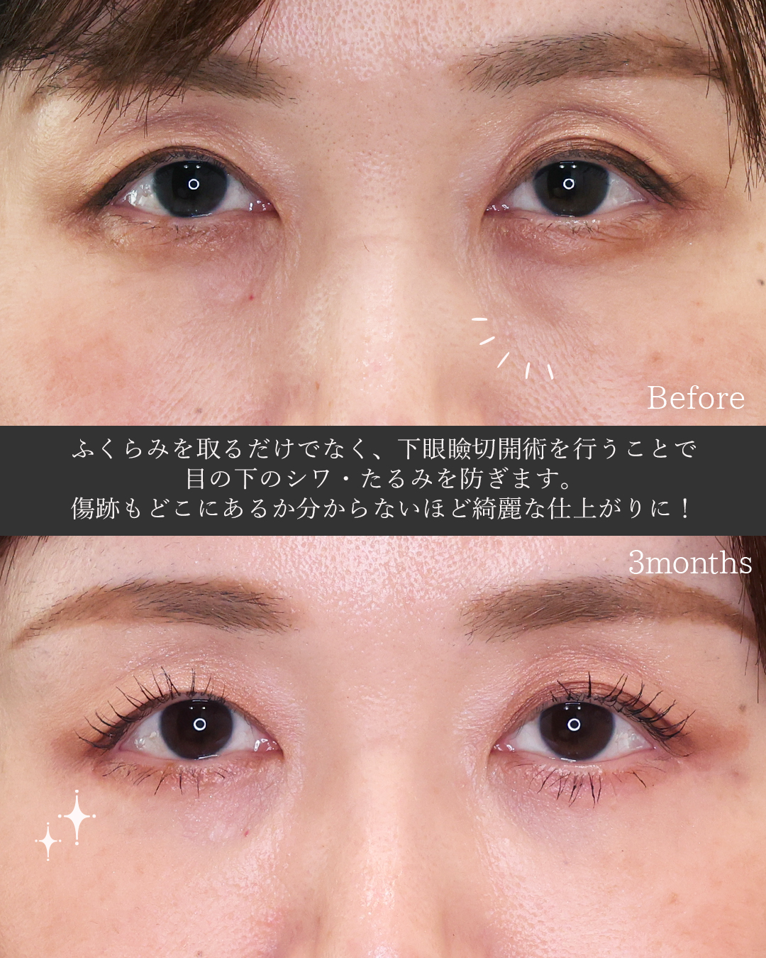 下眼瞼切開術（クマ・たるみとり）/下眼瞼脱脂術（目の下のたるみ取り・目の下の脂肪ふくらみ取り）の症例写真 施術前後 