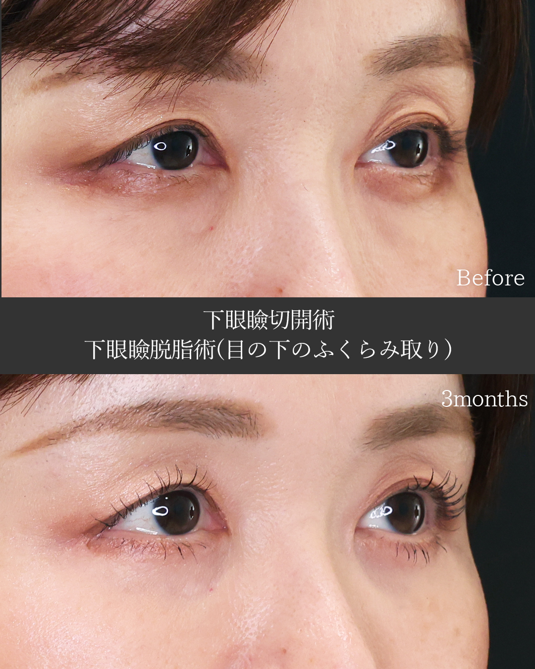 下眼瞼切開術（クマ・たるみとり）/下眼瞼脱脂術（目の下のたるみ取り・目の下の脂肪ふくらみ取り）の症例写真 施術前後 