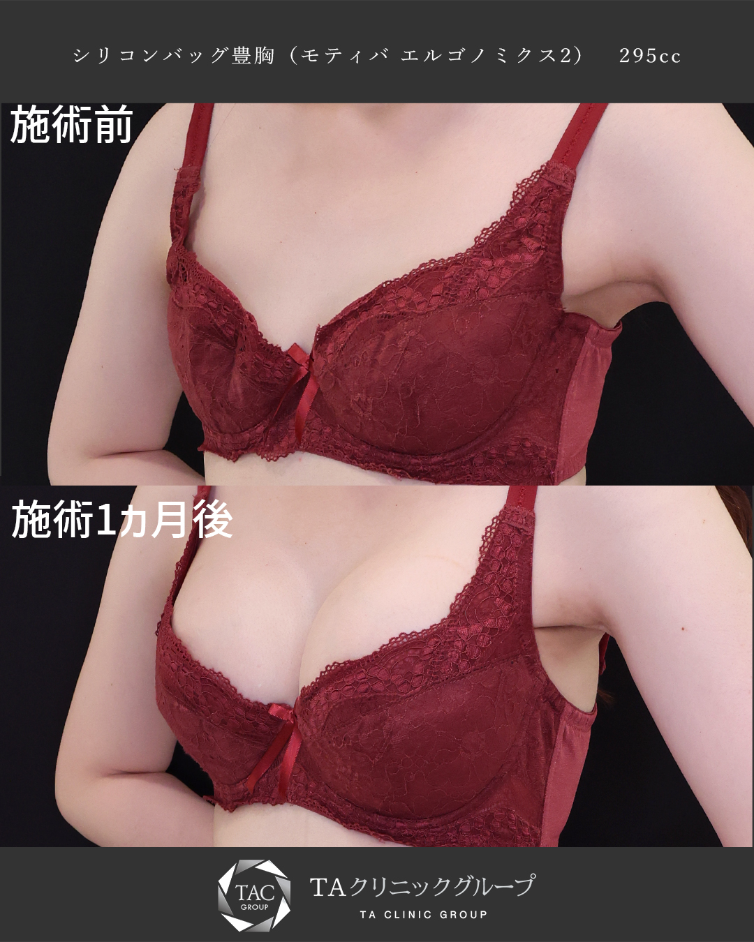 シリコンバッグ豊胸で2カップup！