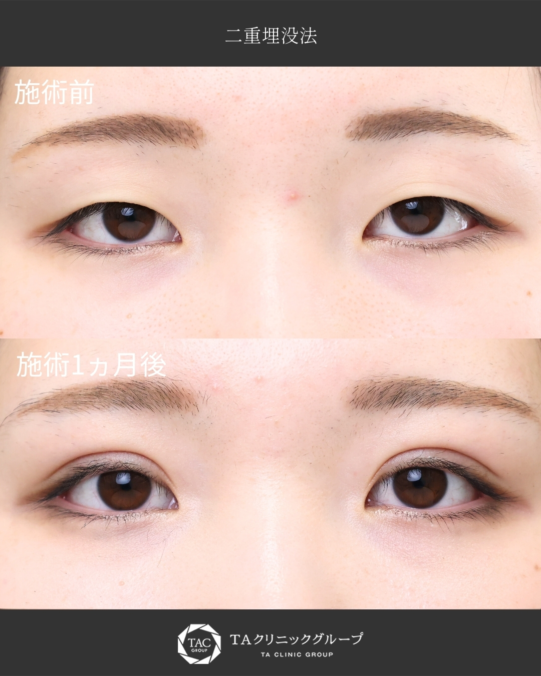 【二重埋没】一重から平行二重に｜まつ毛の生え際がしっかり見えるように！