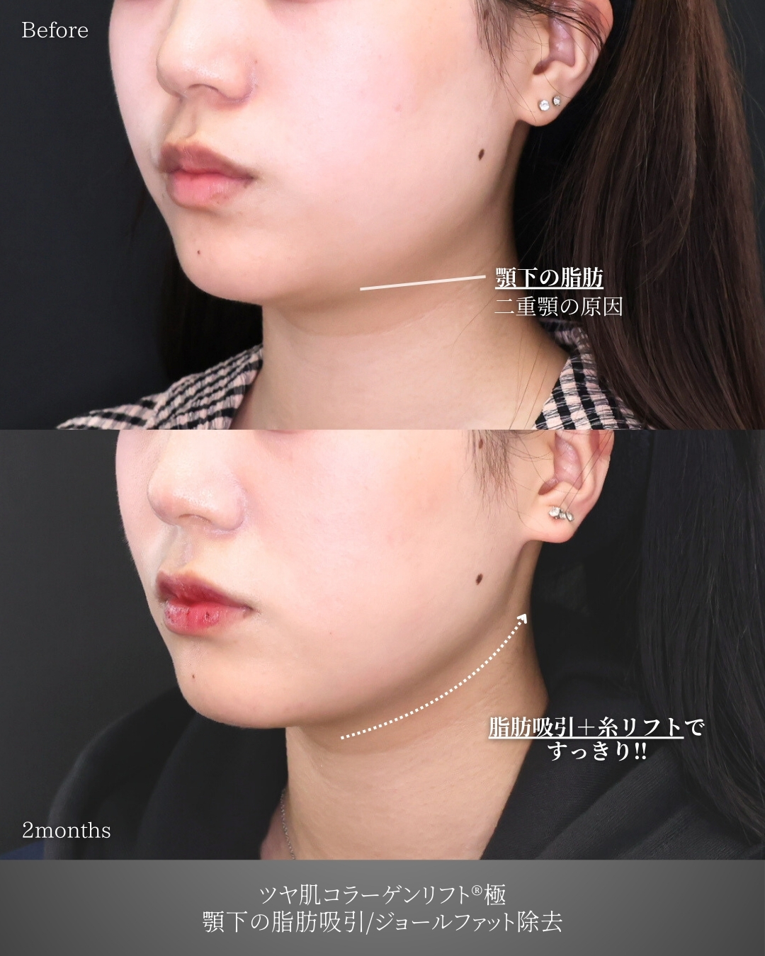 ジョールファット除去/顎下の脂肪吸引・顔の脂肪吸引/TAC式 ツヤ肌コラーゲンリフト®の症例写真 施術前後 