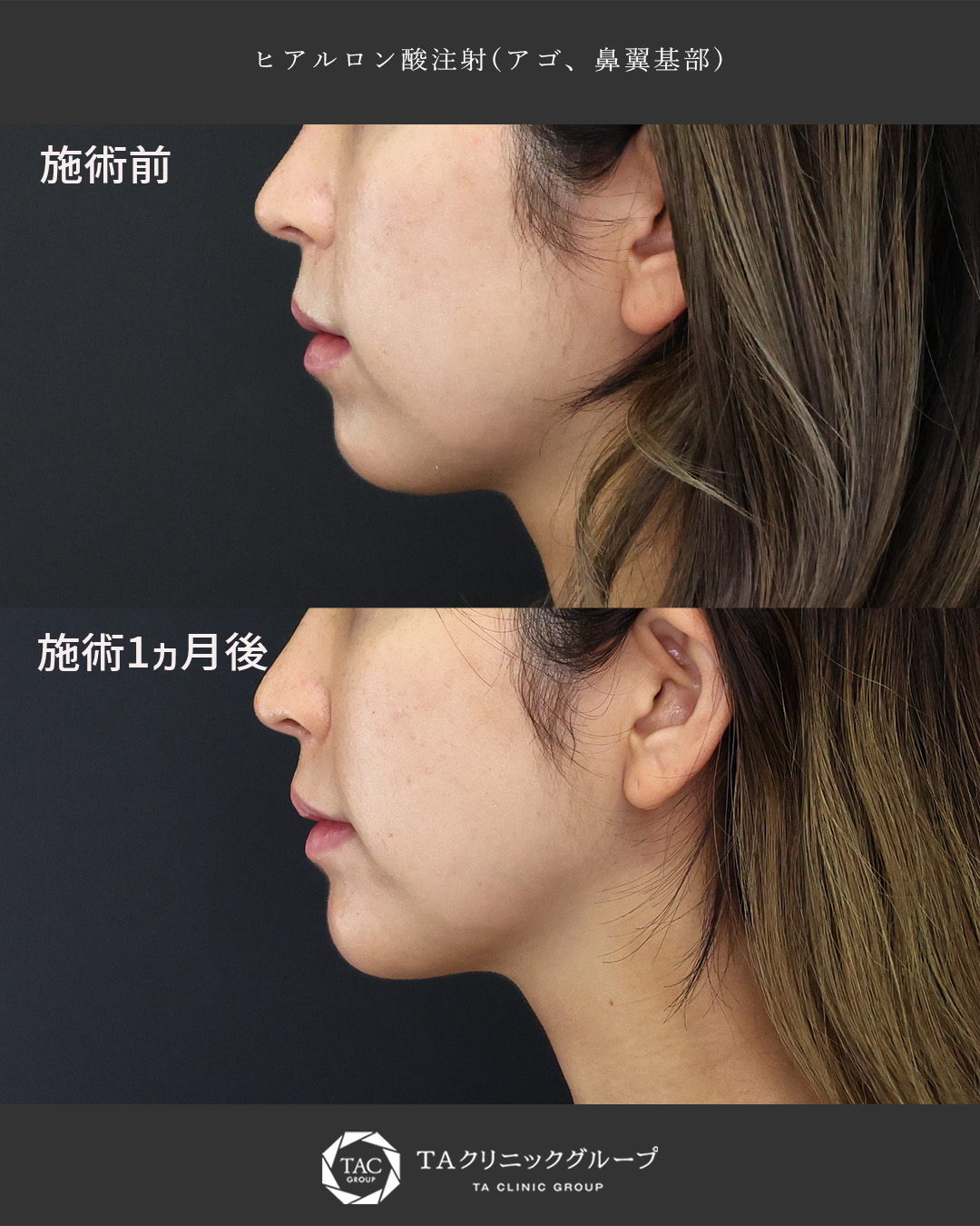 顎のヒアルロン酸注射/ヒアルロン酸注射：その他の症例写真 施術前後 