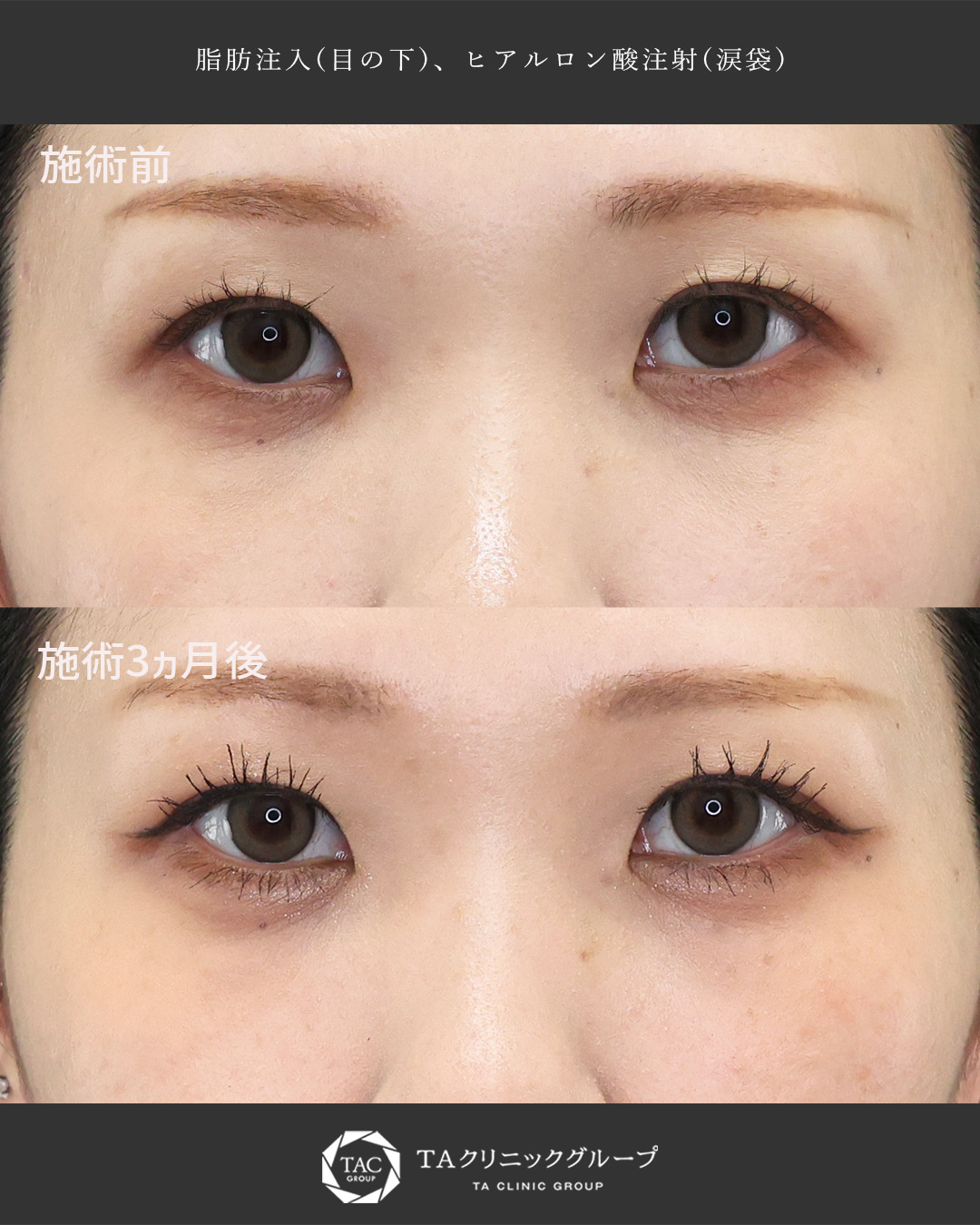 【他院修正】クマ取りで凹んでしまった窪みを改善！