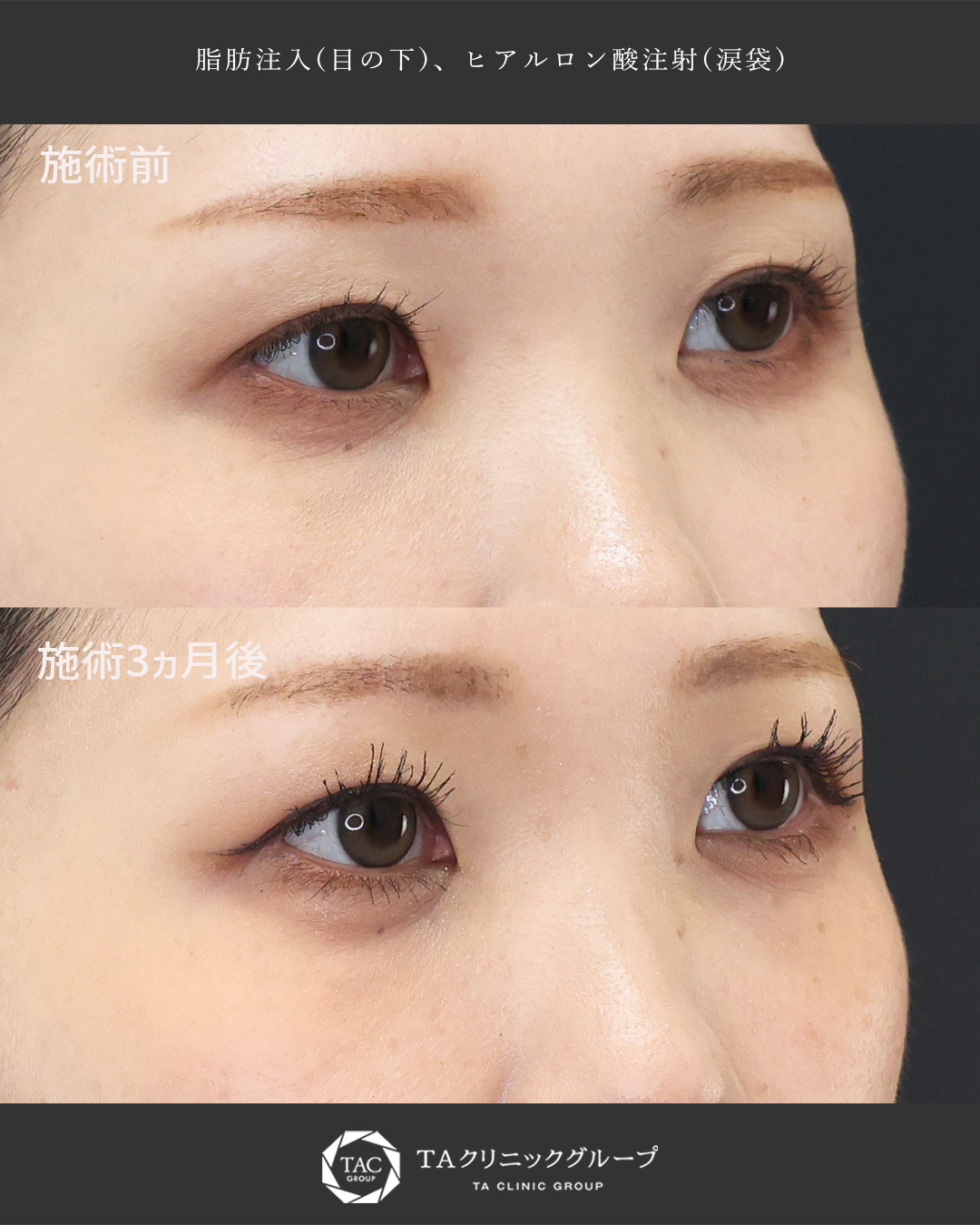 顔の脂肪注入(コンデンスリッチフェイス)/涙袋形成（ヒアルロン酸注射）の症例写真 施術前後 