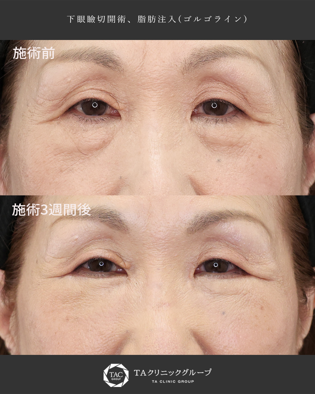 【60代】クマ取り×脂肪注入│目元の若返り