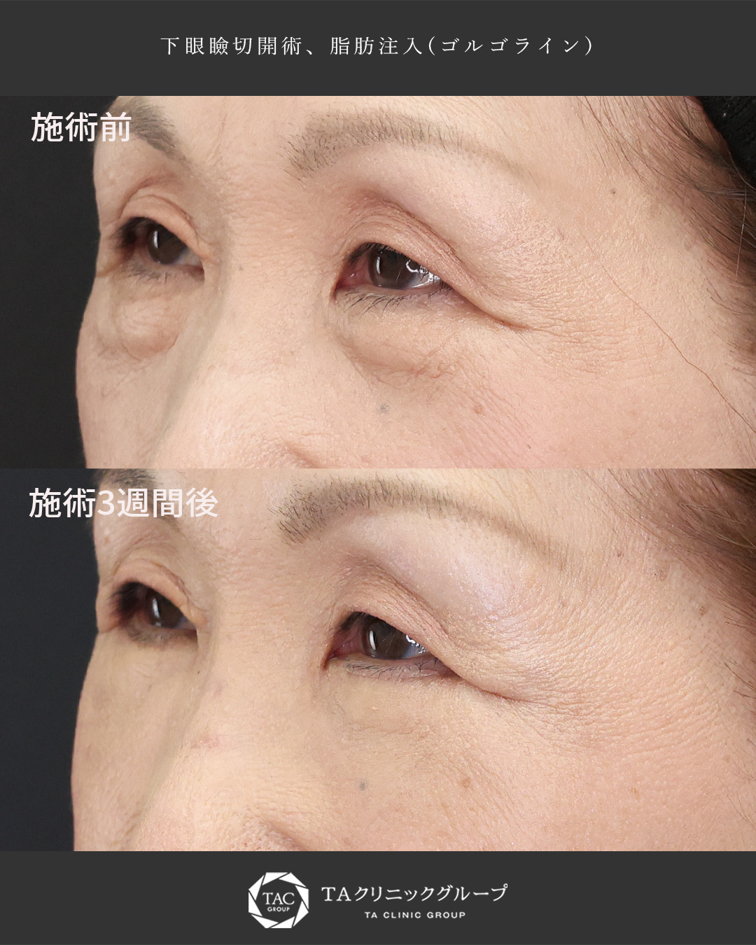 下眼瞼切開術（クマ・たるみとり）/顔の脂肪注入(コンデンスリッチフェイス)の症例写真 施術前後 