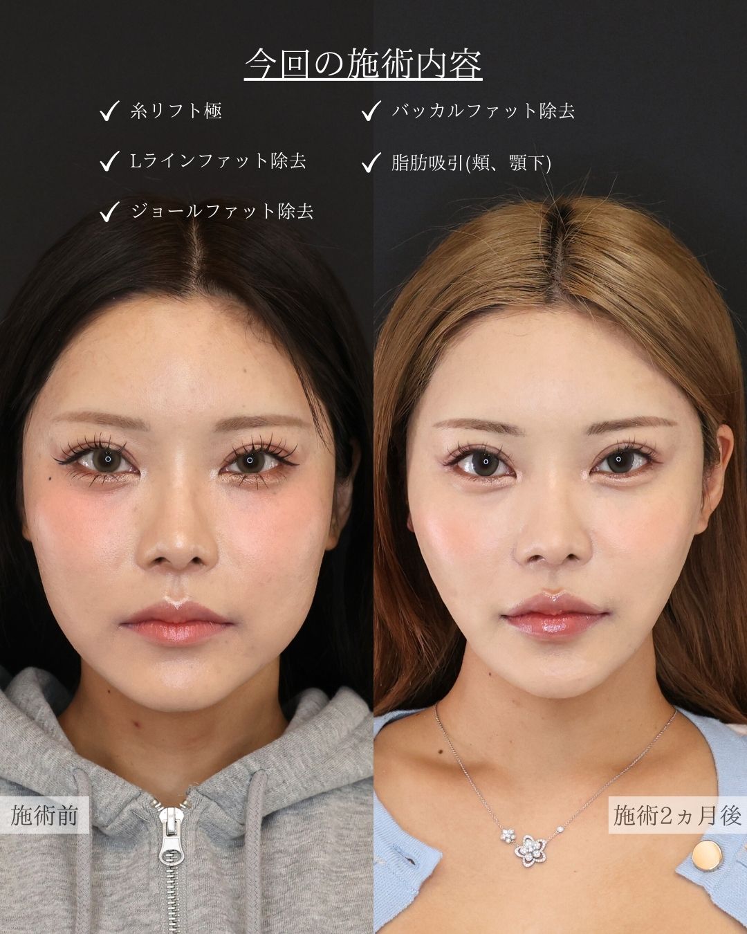 TAC式 ツヤ肌コラーゲンリフト®/Lラインファット除去（エラ下脂肪除去）/ジョールファット除去の症例写真 施術前後 