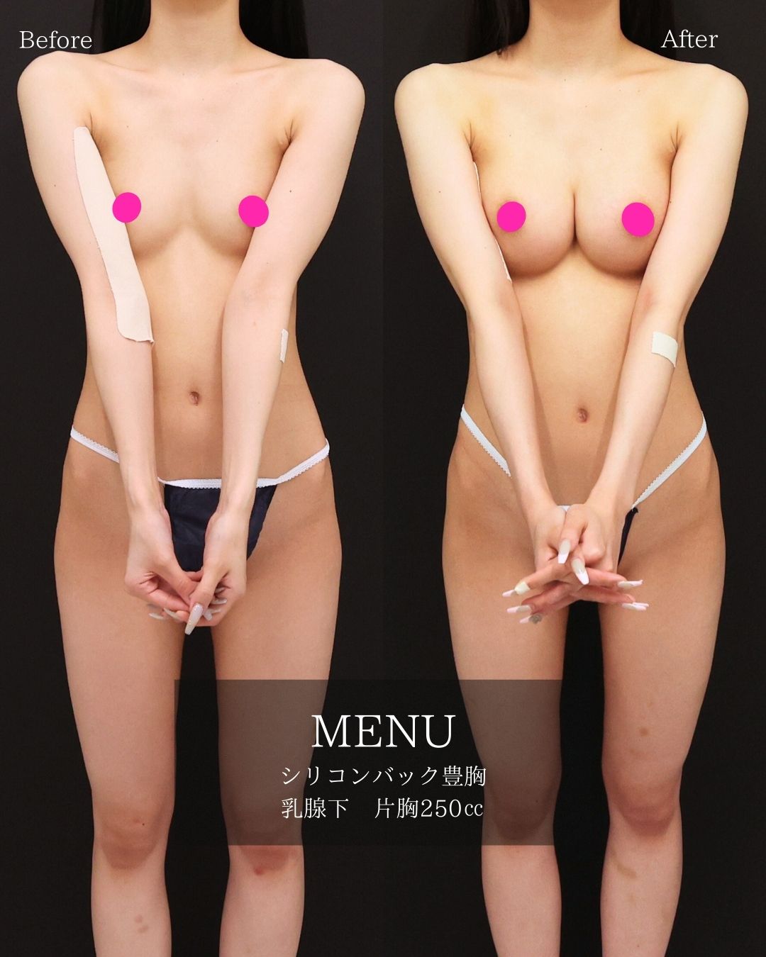 豊胸・バスト：その他/シリコンバッグ豊胸（人工乳腺バッグ）の症例写真 施術前後 