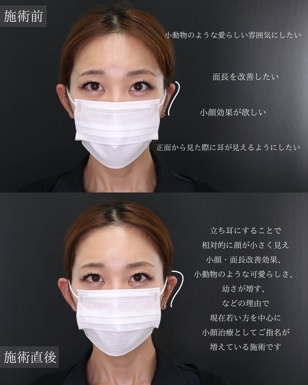 ヒアルロン酸注射：その他の症例写真 施術前後 