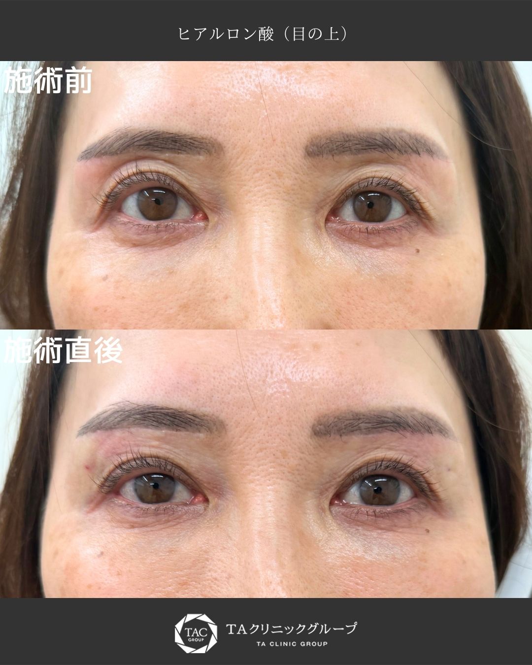 《上まぶたのくぼみをヒアルロン酸で自然に改善｜目元の若返り治療【施術直後の症例】》