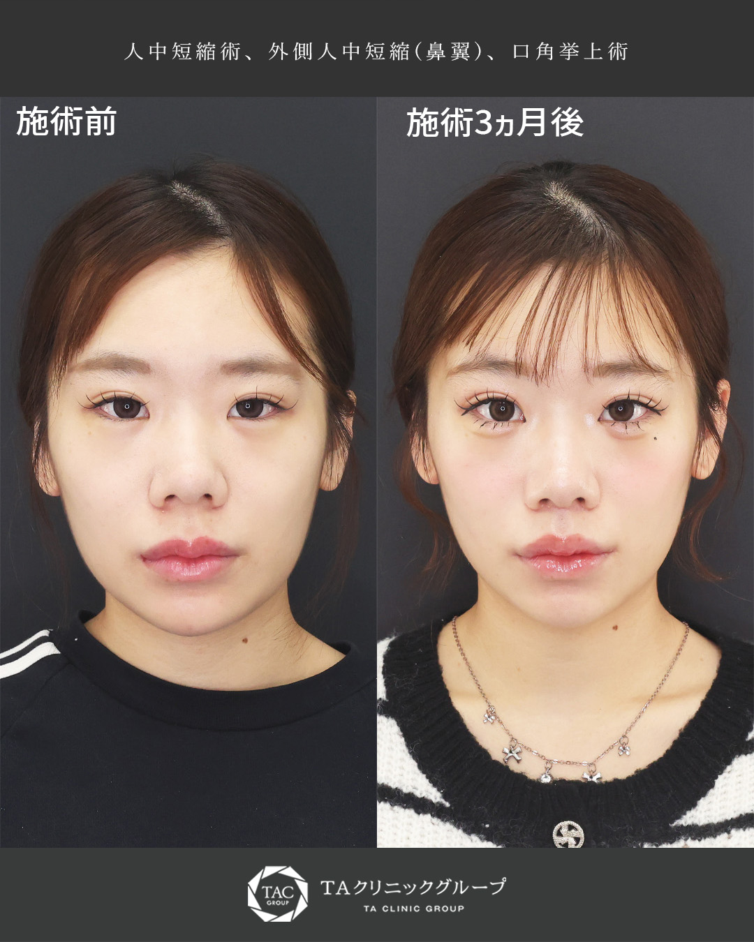 中顔面短縮見え｜形成外科専門医が行う、人中短縮＆口角挙上症例