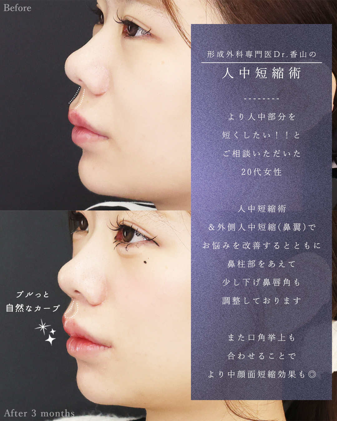 人中短縮術(リップリフト)・外側人中短縮術/口角挙上・リフト（マイクロ切開法・内側法/口内法）の症例写真 施術前後 