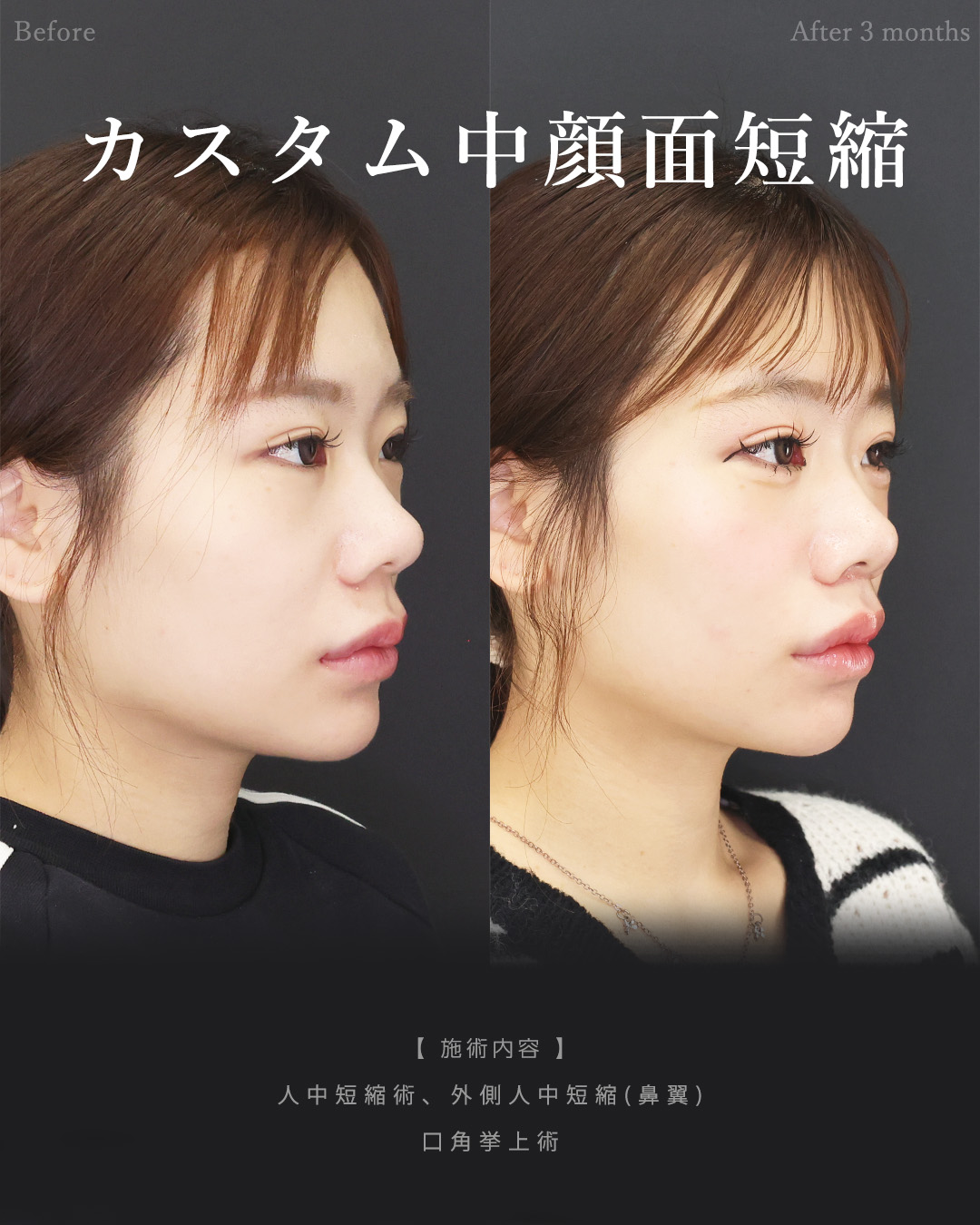 人中短縮術(リップリフト)・外側人中短縮術/口角挙上・リフト（マイクロ切開法・内側法/口内法）の症例写真 施術前後 