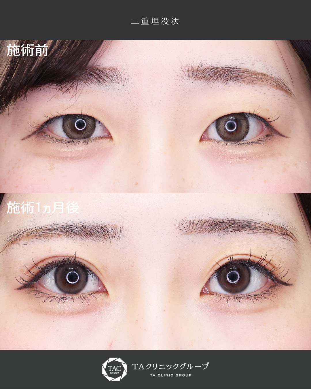【ダウンタイム最小!!】二重埋没で一重から平行二重に｜メイク映え