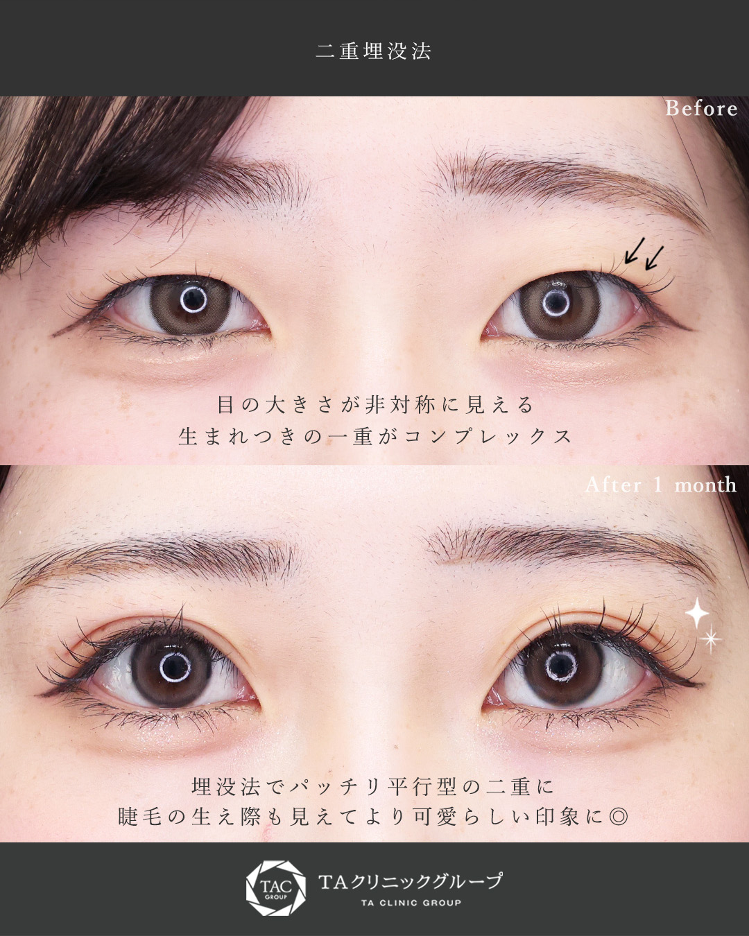 二重埋没法の症例写真 施術前後 