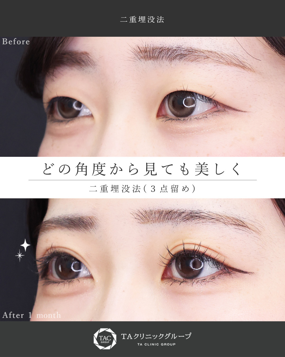 二重埋没法の症例写真 施術前後 