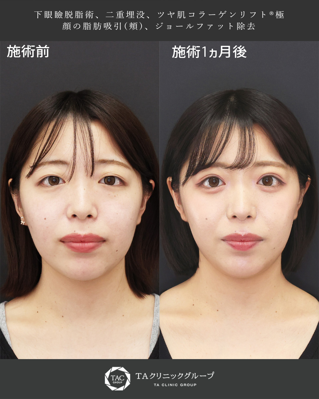 クマ取り×埋没×小顔整形｜形成外科専門医執刀、別人級の整形変化!!