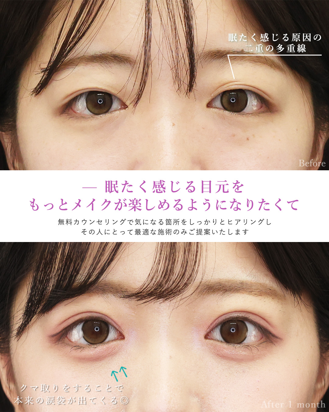 下眼瞼脱脂術（目の下のたるみ取り・目の下の脂肪ふくらみ取り）/二重埋没法/TAC式 ツヤ肌コラーゲンリフト®の症例写真 施術前後 