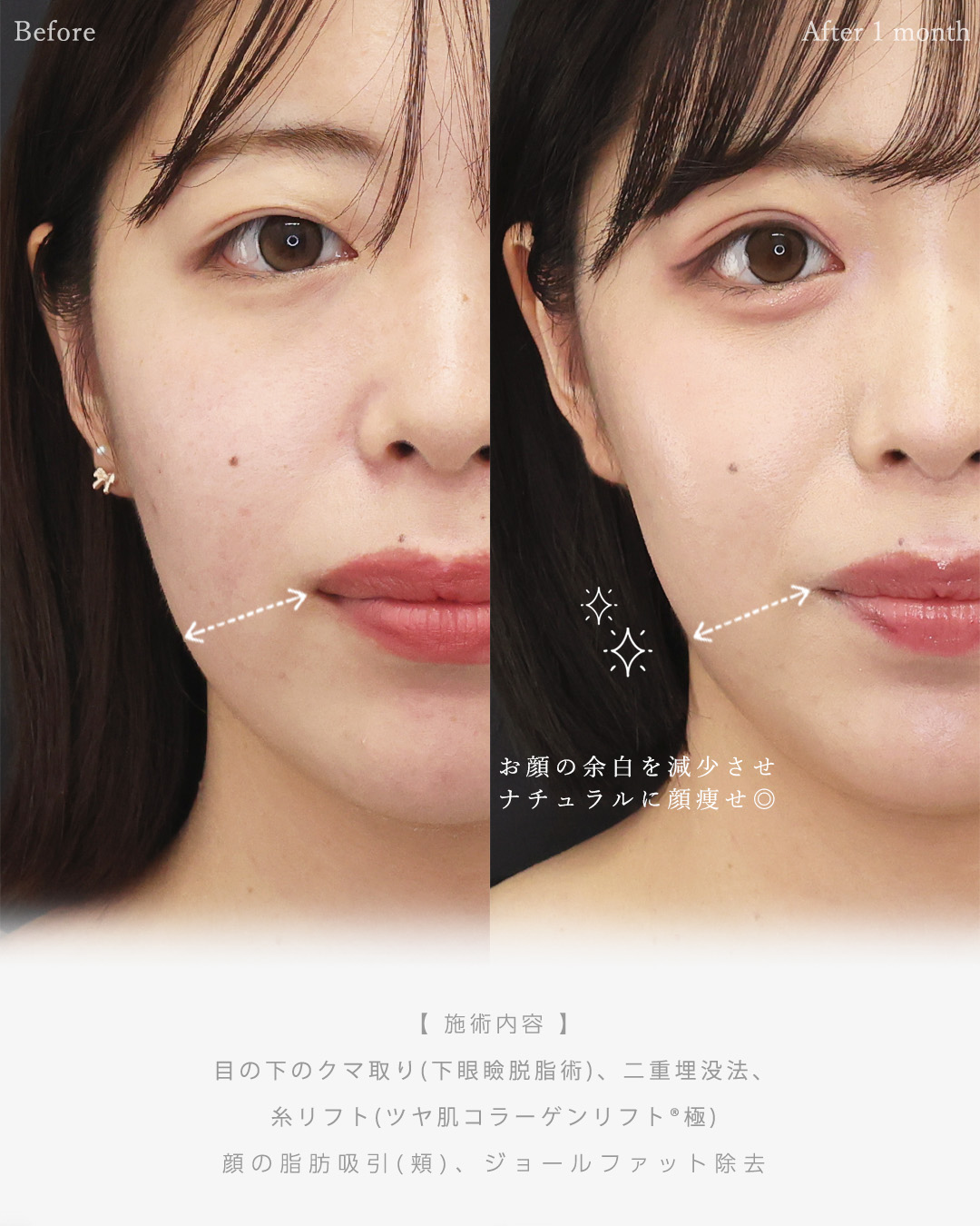 下眼瞼脱脂術（目の下のたるみ取り・目の下の脂肪ふくらみ取り）/二重埋没法/TAC式 ツヤ肌コラーゲンリフト®の症例写真 施術前後 