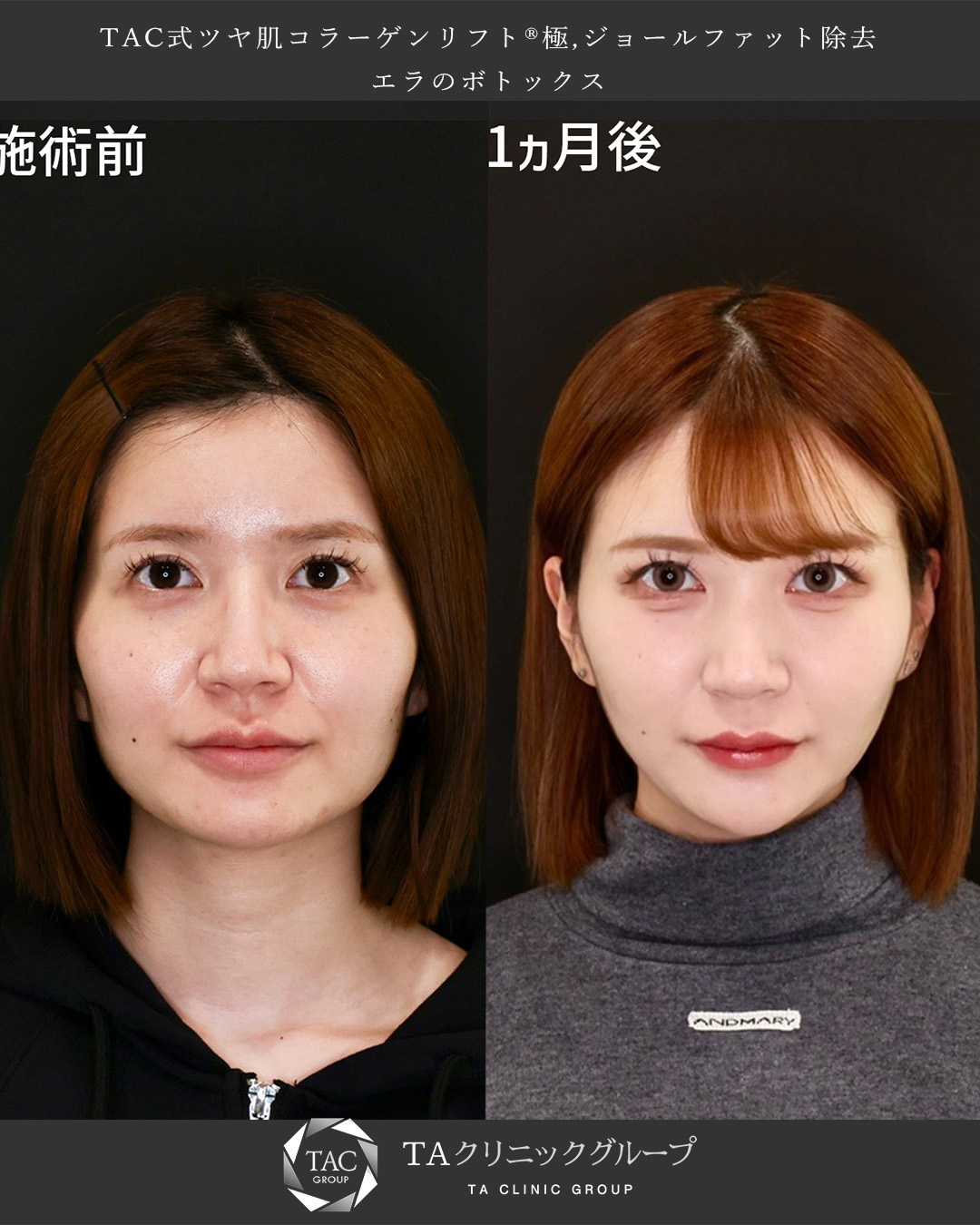 カクカク輪郭をすっきりバブみフェイスに！