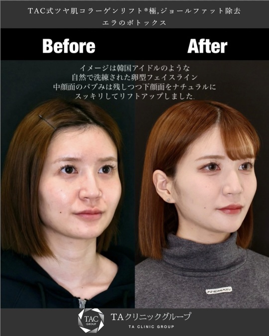 TAC式 ツヤ肌コラーゲンリフト®/エラボトックス注射/ジョールファット除去の症例写真 施術前後 
