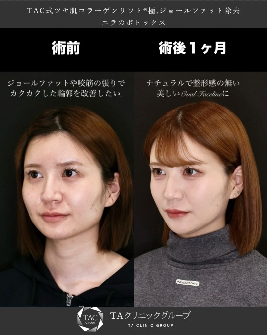 TAC式 ツヤ肌コラーゲンリフト®/エラボトックス注射/ジョールファット除去の症例写真 施術前後 