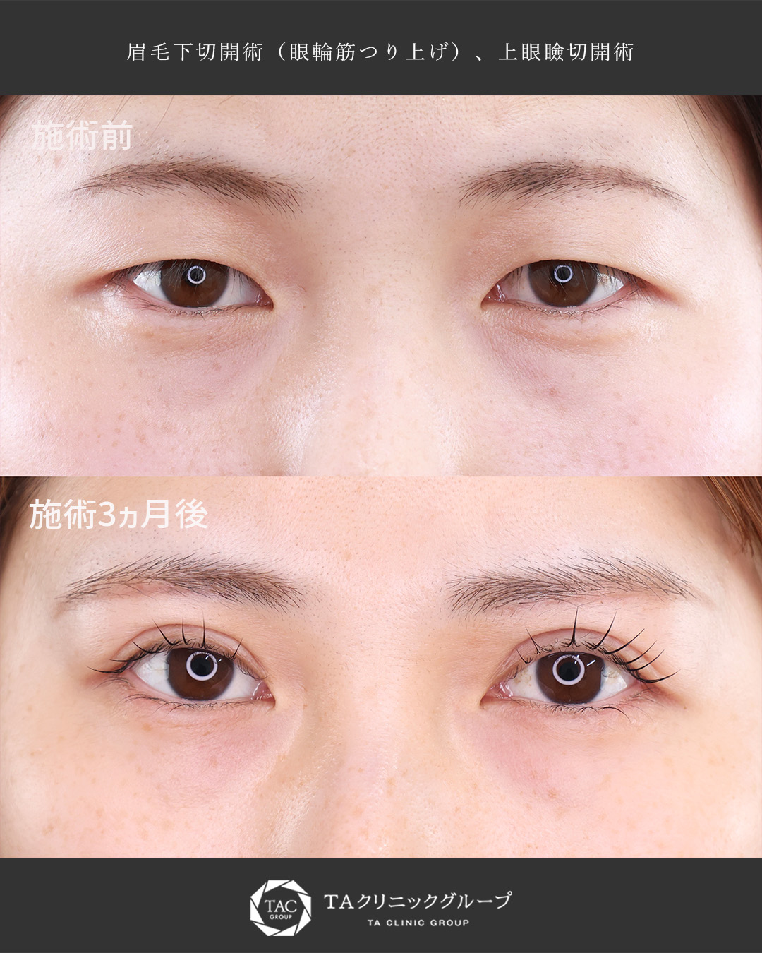 形成外科専門医の目元複合施術｜眉毛下切術＋上眼瞼切開術