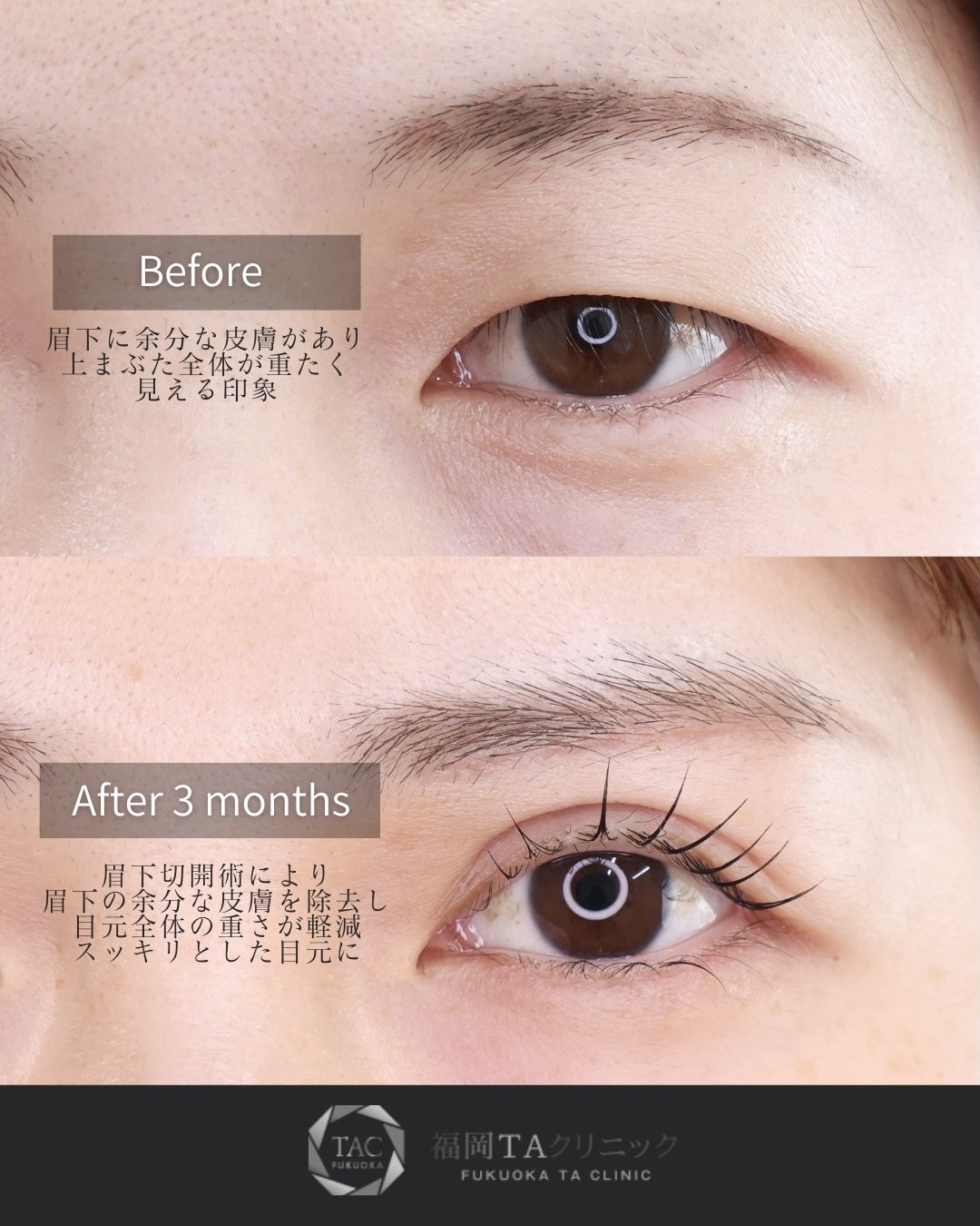 眉毛下切開術/上眼瞼切開術の症例写真 施術前後 