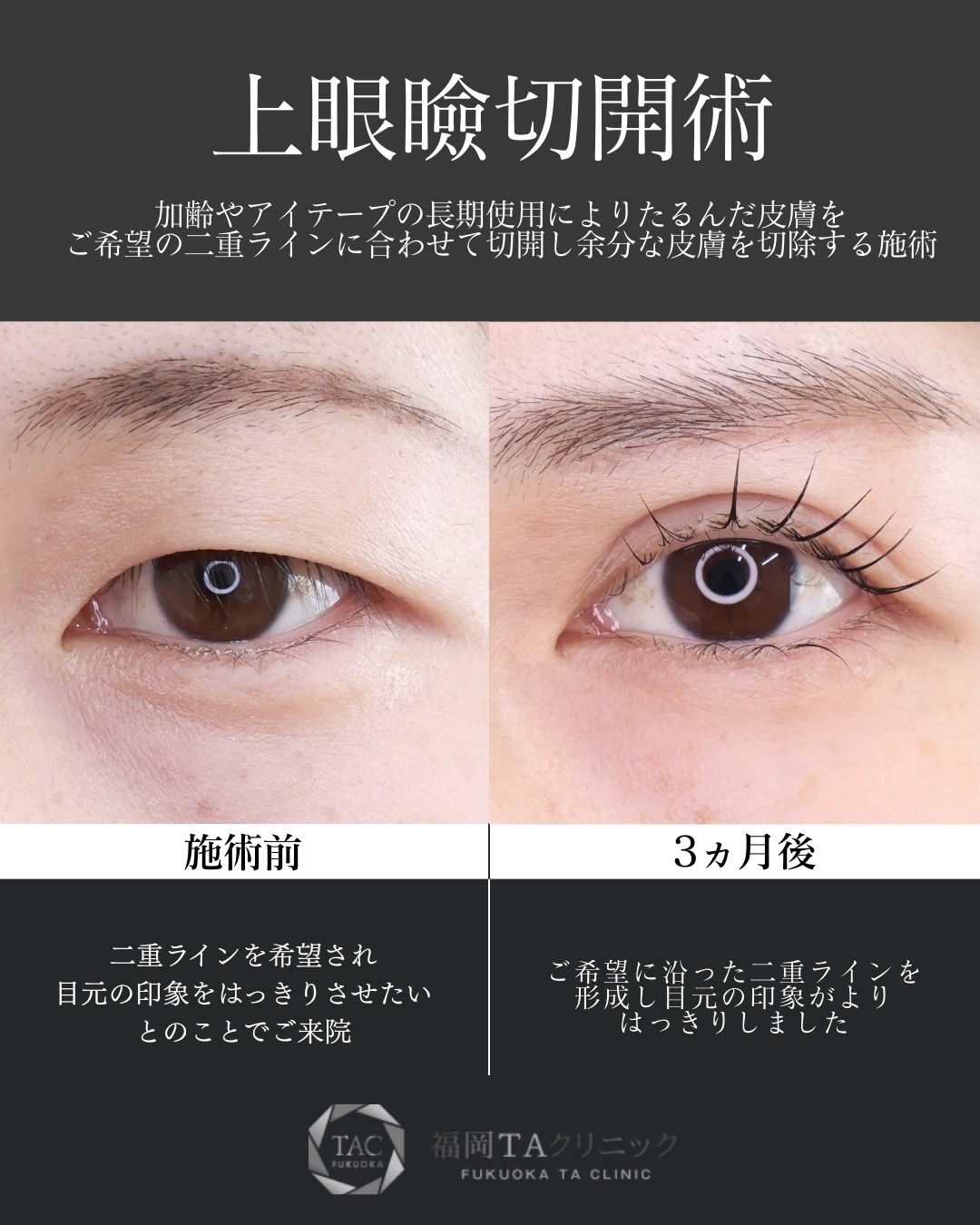 眉毛下切開術/上眼瞼切開術の症例写真 施術前後 