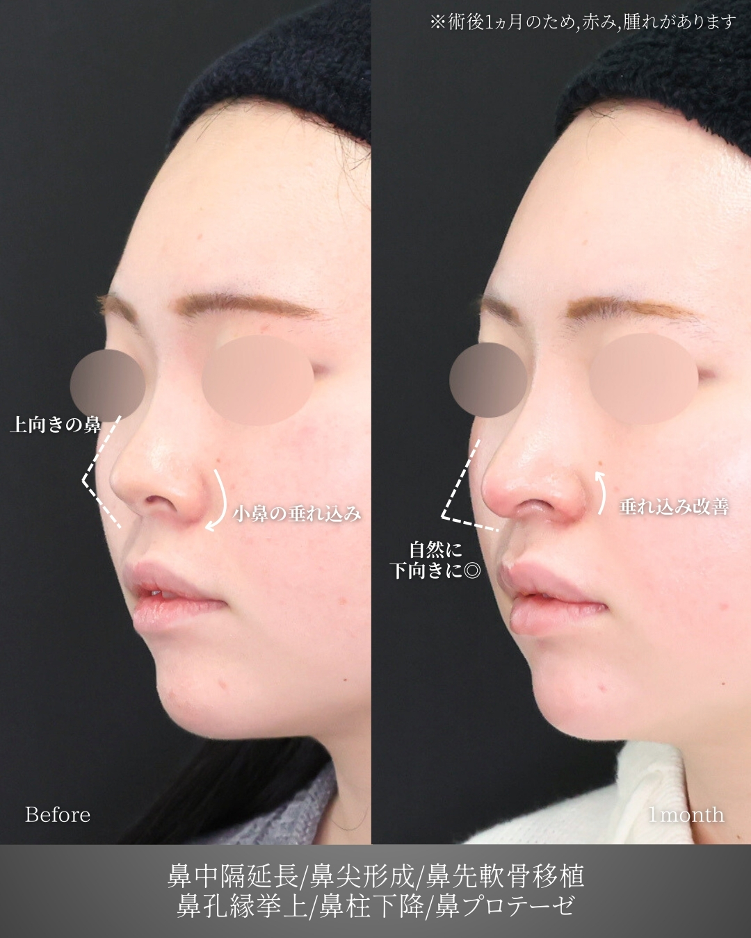 鼻中隔延長術/鼻尖形成・鼻尖縮小/鼻先軟骨移植の症例写真 施術前後 