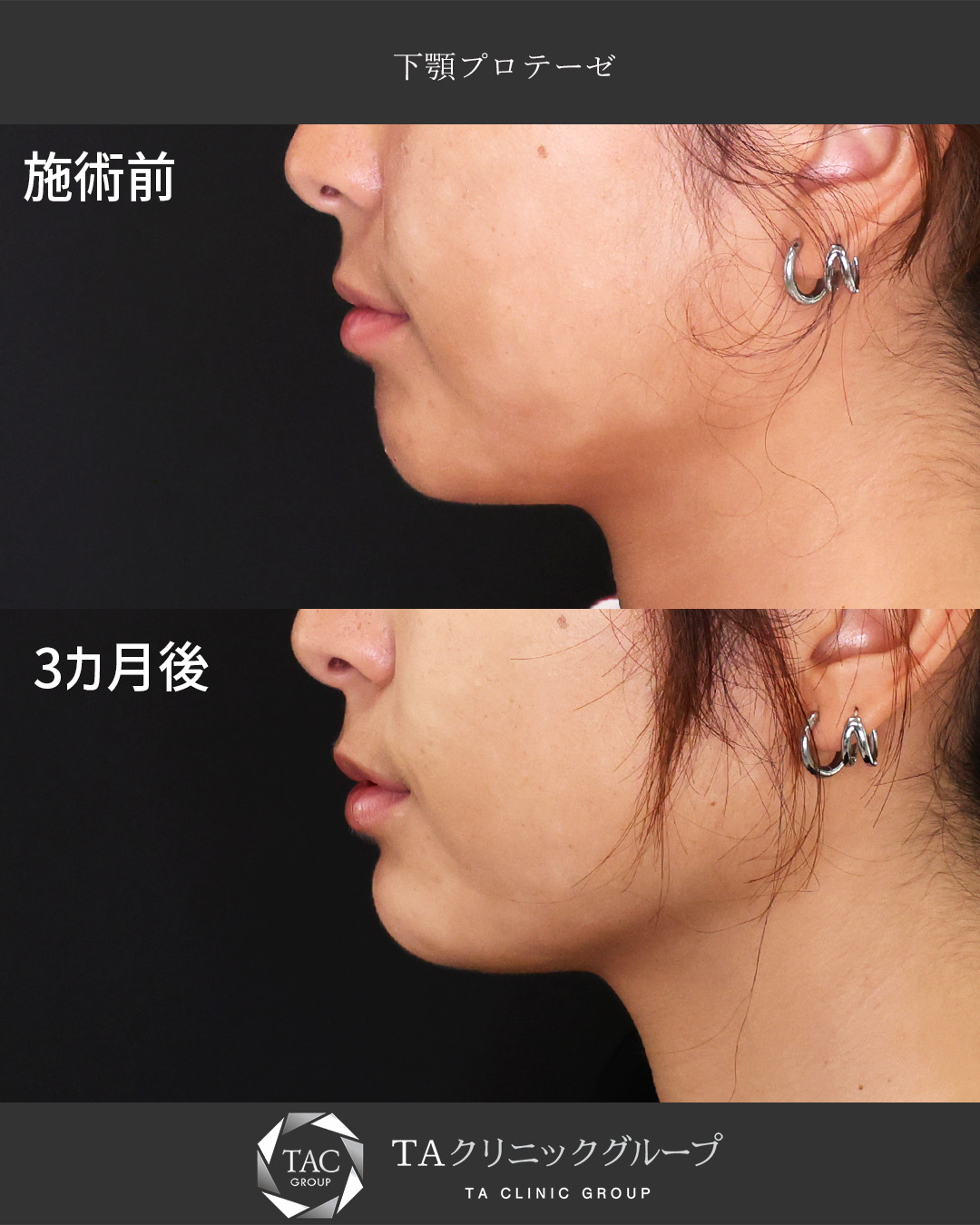 【顎プロテーゼ】顎ヒアル卒業！半永久的な横顔美人に