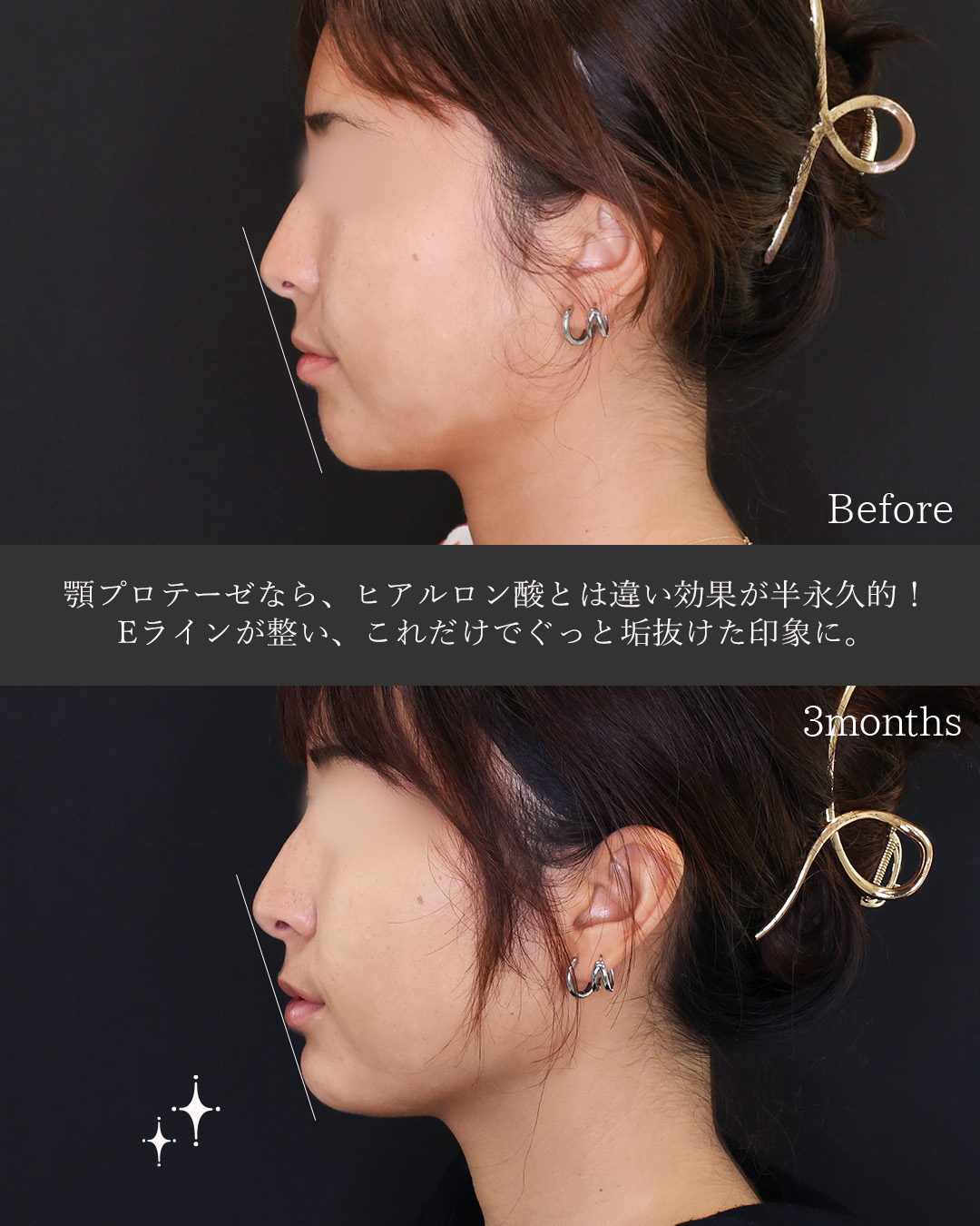 下顎プロテーゼの症例写真 施術前後 