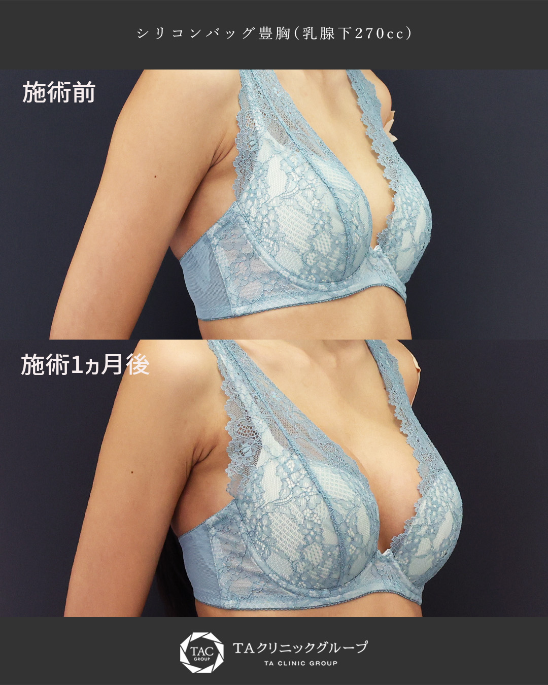 シリコンバッグ豊胸（人工乳腺バッグ）の症例写真 施術前後 