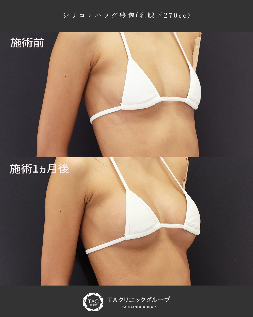 やせ型でも自然なふっくらバストに！│シリコンバッグ豊胸